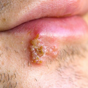 Blisters – Causes and how to heal blisters quickly