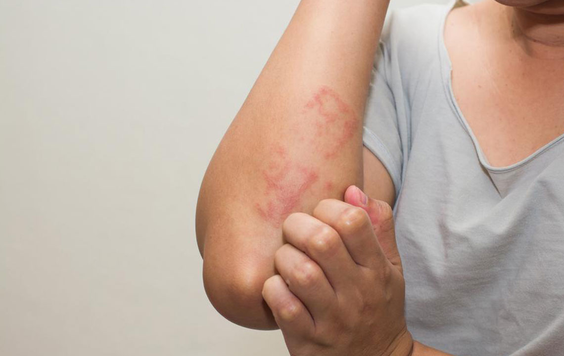 Eczema – Types, Causes, Symptoms, and Treatment